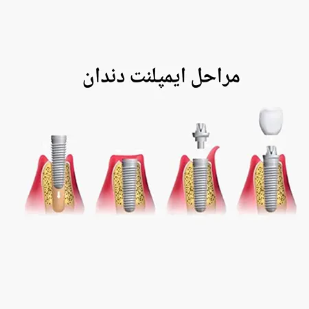 مراحل-ایمپلنت-دندان