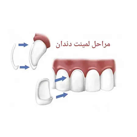 مراحل-لمینت-دندان-1