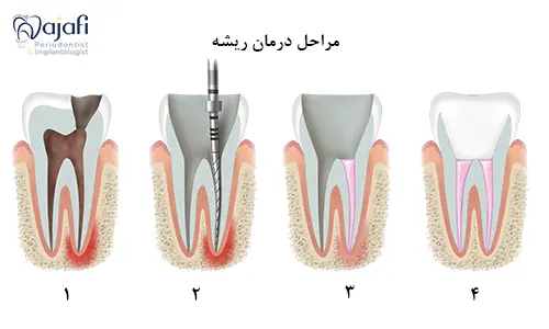 مراحل درمان ریشه دندان 