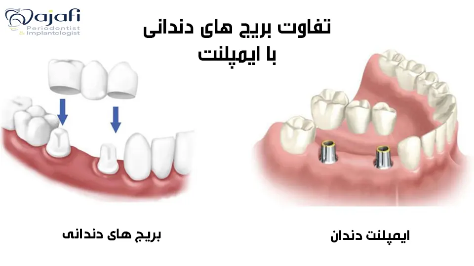 تفاوت بریج دندانی با ایمپلنت 