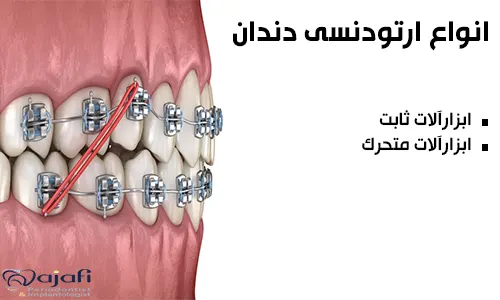 انواع-ارتودنسی-دندان