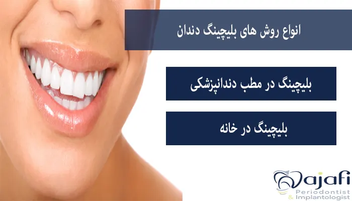 انواع روش های بلیچینگ دندان