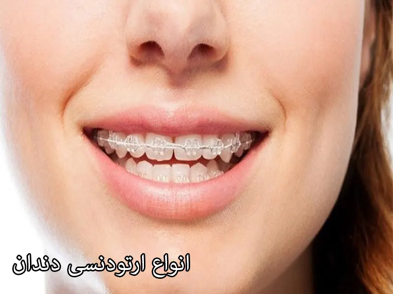 انواع-ارتودنسی-دندان