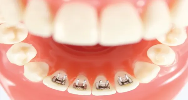 کاربرد ارتودنسی پشت دندانی 