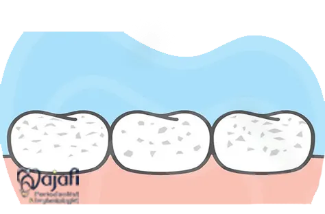 نشانه های فلوئورزیس دندانی