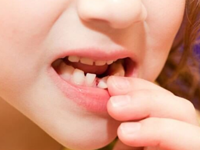 مراقبتاز دندان شیری