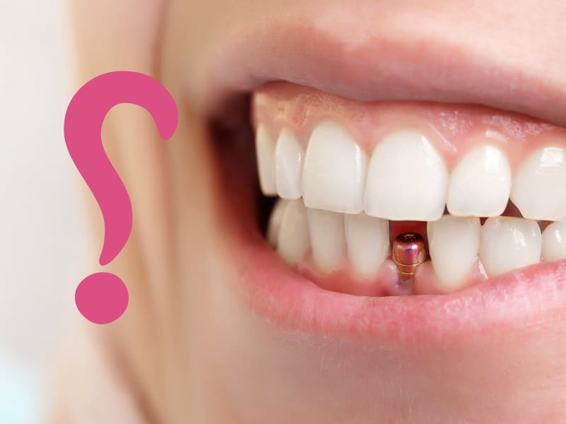 سوالات متدوال ایمپلنت دندان