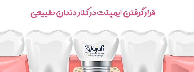 قرارگفتن ایمپلنت در کنار دندان طبیعی در افراد مناسب ایمپلنت