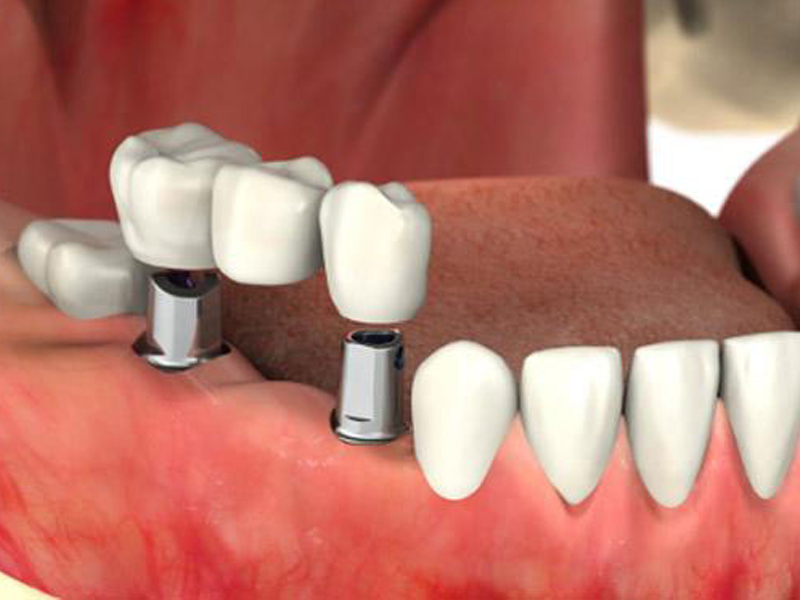مراقبت های ایمپلنت دندان