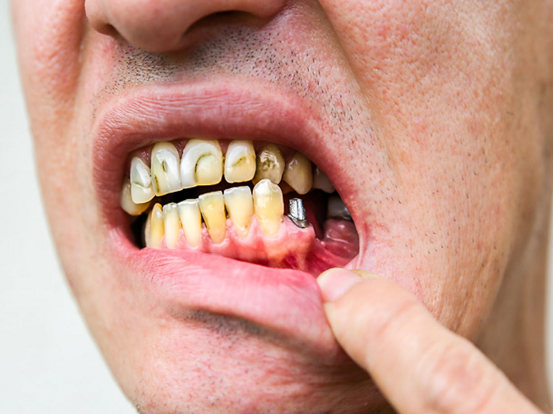 عوارض ایمپلنت دندان