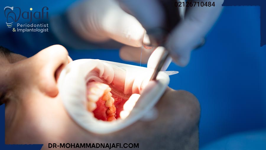 مراقبت بعد از جراحی افزایش طول تاج دندان